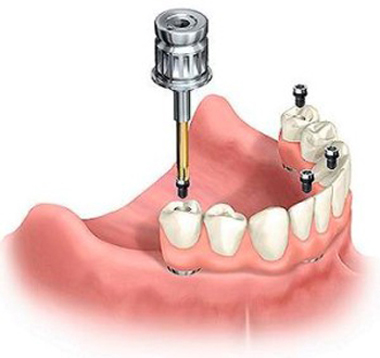 Diagram of implant overdentures with the denture teeth being screwed onto implants.