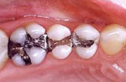 Mercury-free dentist befoe photo of three lower molar teeth with amalgam fillings.
