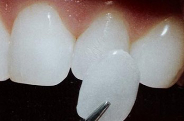 Photo of a thin porcelain veneer held up to an incisor tooth.