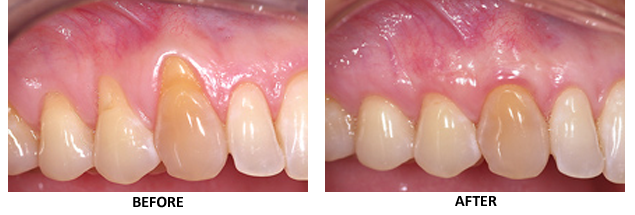 Before-and-after gum recession treatment photos; for information about Sugar Land periodontal treatment from Dr. Siny Thomas.