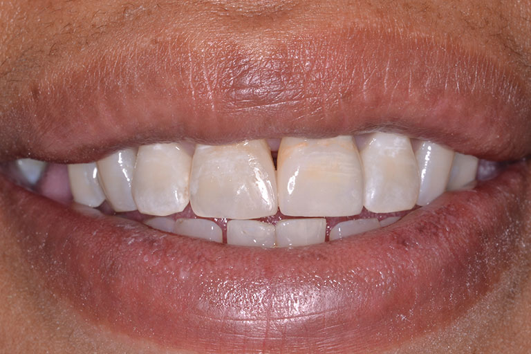 mans smile showing new single crown on front tooth