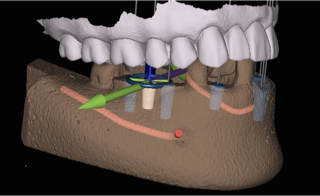 Diagram of X-Nav dental implant guide, available in Sugar Land from Dr. Siny Thomas.