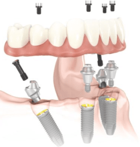 illustration of all-on-four dental implants