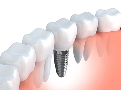 A diagram of a dental implant between two teeth