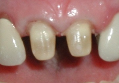 Preparation for dental crowns