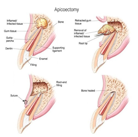 Stage of apicoectomy