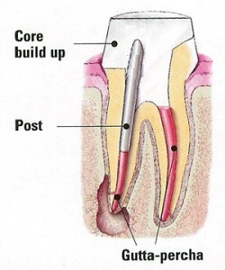 Diagram of a metal post in a tooth that was used cor a core buildup