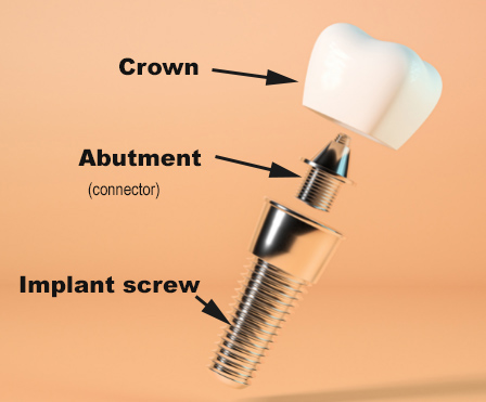 Standing, unassembled dental implant with crown, abutment, and screw