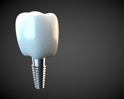 Dental implant model for a molar tooth