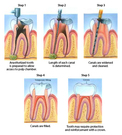 Five steps of root canal treatment