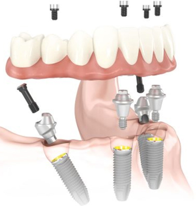 Diagram of All-on-4 dental implants, available from Sugar Land, TX dentist Dr. Siny Thomas
