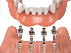 Diagram of an implant denture hovering above four implants
