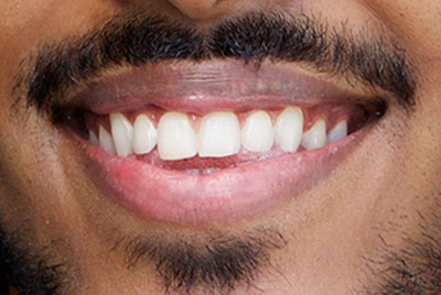 Close-up of a man's smile with a moustache, for information on gum surgery and dental veneers available in Sugar Land from Dr. Siny Thomas.