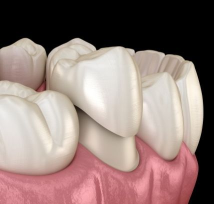 Digital model of a dental crown vs tooth removal