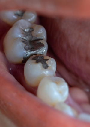 Three lower molar teeth with silver fillings, for information on Sugar Land sanitary amalgam removal