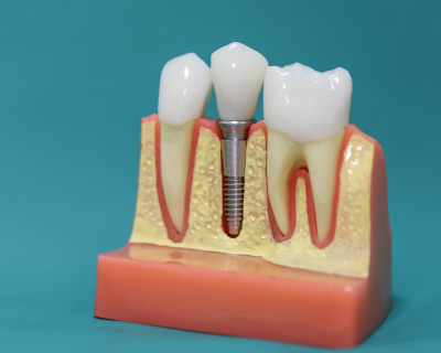 Model of a dental implant and crown between two natural teeth