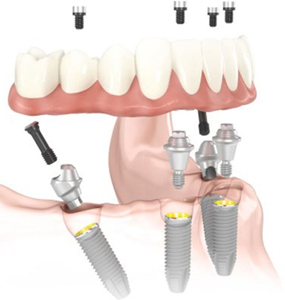 All-on-4 dental implants supporting a lower denture, for information on US dental implant brands