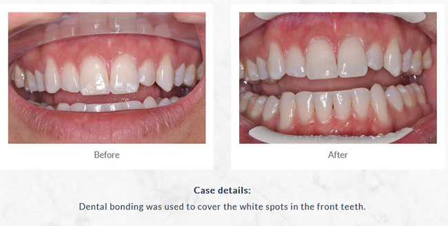 Before and after dental bonding patient photos from Sugar Land dentist Dr. Siny Thomas