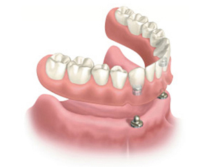 Diagram of a snap-on denture