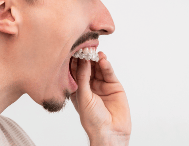 A man putting a clear retainer in his mouth