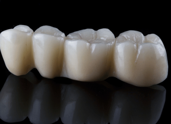 Dental bridge with four crowns
