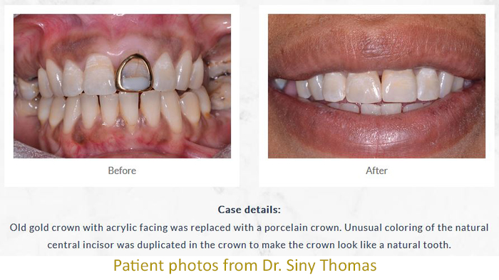 Before and after dental crowns photos for a dark tooth - from Sugar Land cosmetic dentist Dr. Siny Thomas