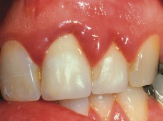 Thick dental crowns with inflamed gums above them